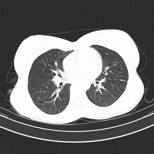Arteria lusoria (Radiopaedia 88528-105192 Axial lung window 35).jpg