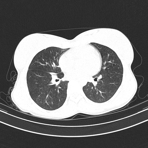 File:Arteria lusoria (Radiopaedia 88528-105192 Axial lung window 37).jpg