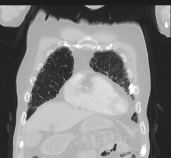 Asbestosis (Radiopaedia 56192-62864 Coronal lung window 12).png
