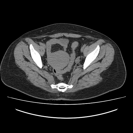 Ascending retrocecal appendicitis with liver abscesses (Radiopaedia 60066-67615 Axial non-contrast 74).jpg