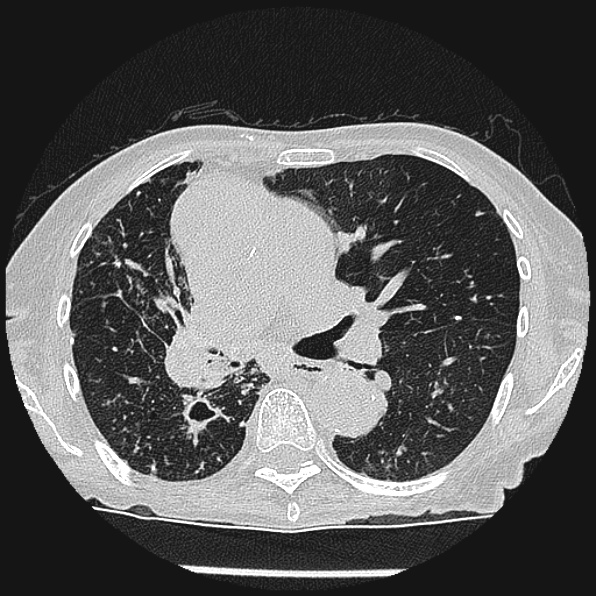 Aspergilloma (Radiopaedia 24458-24763 Axial lung window 31).jpg