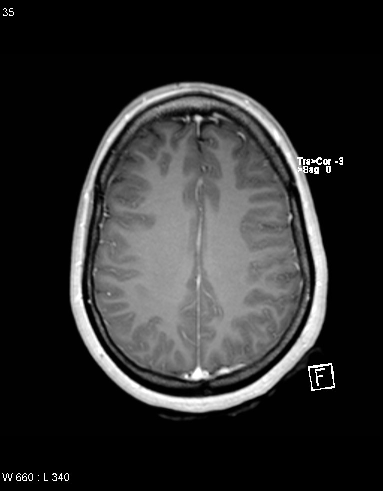 Astroblastoma (Radiopaedia 39792-42218 Axial T1 C+ 34).jpg