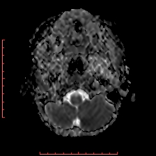 Astroblastoma (Radiopaedia 74287-85162 Axial ADC 2).jpg