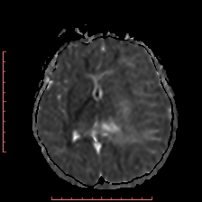 Astroblastoma (Radiopaedia 74287-85162 Axial ADC 31).jpg