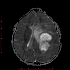 File:Astroblastoma (Radiopaedia 74287-85162 Axial ADC 37).jpg