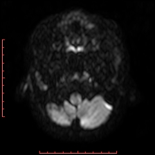 Astroblastoma (Radiopaedia 74287-85162 Axial DWI 3).jpg