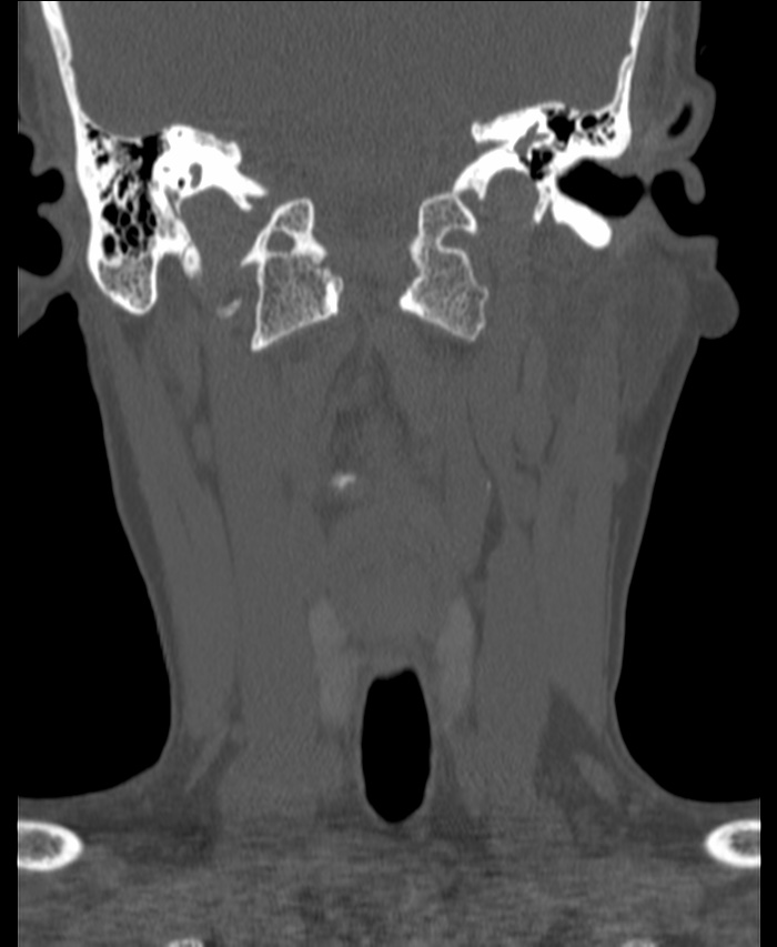 Atlanto-occipital assimilation with basilar invagination (Radiopaedia 70122-80188 Coronal bone window 58).jpg