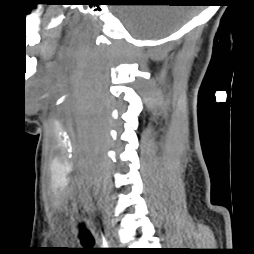 File:Atlanto-occipital dislocation (Radiopaedia 44648-48412 A 9).jpg