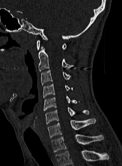 Atlantoaxial subluxation (Radiopaedia 44681-48450 Sagittal bone window 87).jpg