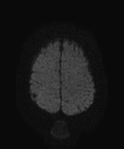 File:Atretic parietal cephalocele (Radiopaedia 64350-73135 Axial DWI 18).jpg