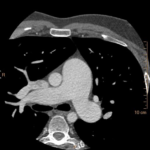 Atrial septal defect (upper sinus venosus type) with partial anomalous pulmonary venous return into superior vena cava (Radiopaedia 73228-83961 A 54).jpg