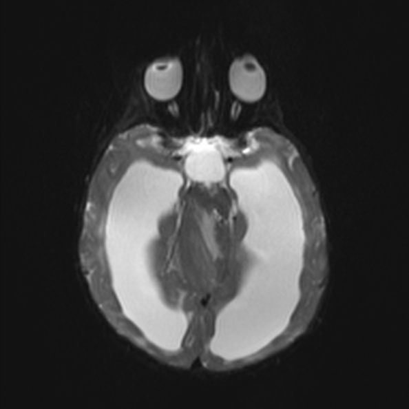 Atypical medulloblastoma (Radiopaedia 34903-36371 Axial DWI 12).jpg