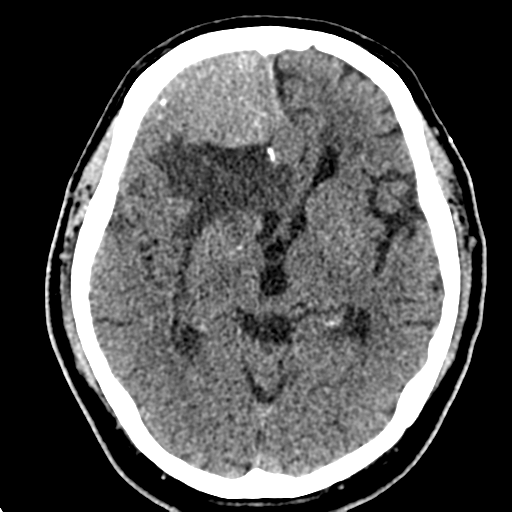 File:Atypical meningioma (WHO grade II) with brain invasion (Radiopaedia 57767-64728 Axial non-contrast 19).png