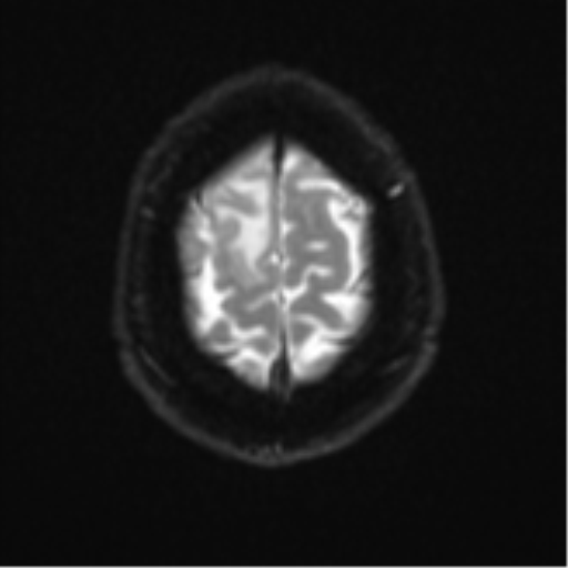 Atypical meningioma (WHO grade II) with brain invasion (Radiopaedia 57767-64729 Axial DWI 27).png