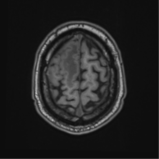 File:Atypical meningioma (WHO grade II) with brain invasion (Radiopaedia 57767-64729 Axial T1 45).png