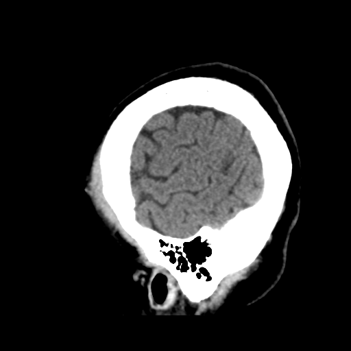 Atypical meningioma (WHO grade II) with osseous invasion (Radiopaedia 53654-59715 C 48).png