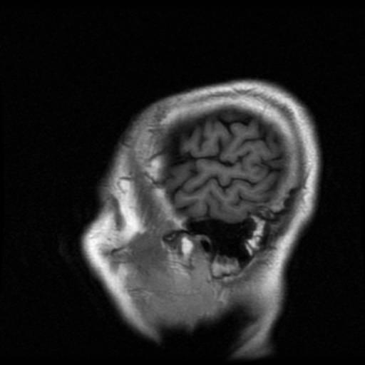 File:Atypical meningioma (WHO grade II) with osseous invasion (Radiopaedia 53654-59716 Sagittal T1 3).png