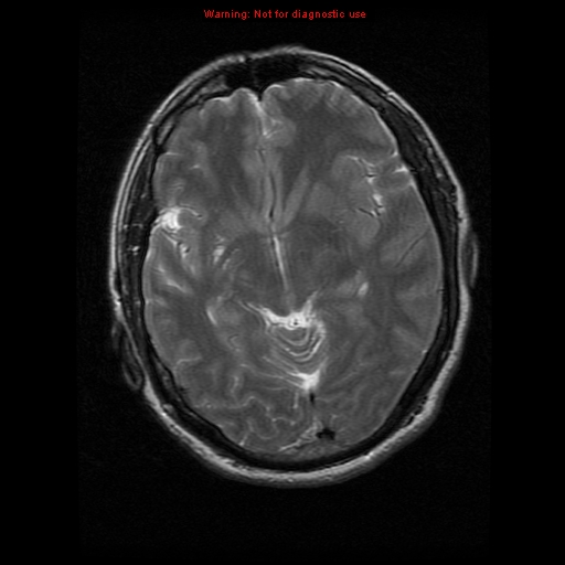 File:Atypical meningioma - grade II (Radiopaedia 13303-13305 Axial T2 10).jpg