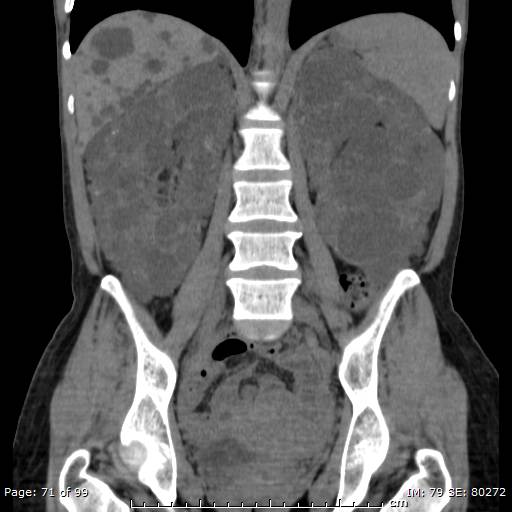File:Autosomal dominant polycystic kidney disease (Radiopaedia 44122-47684 Coronal 14).jpg