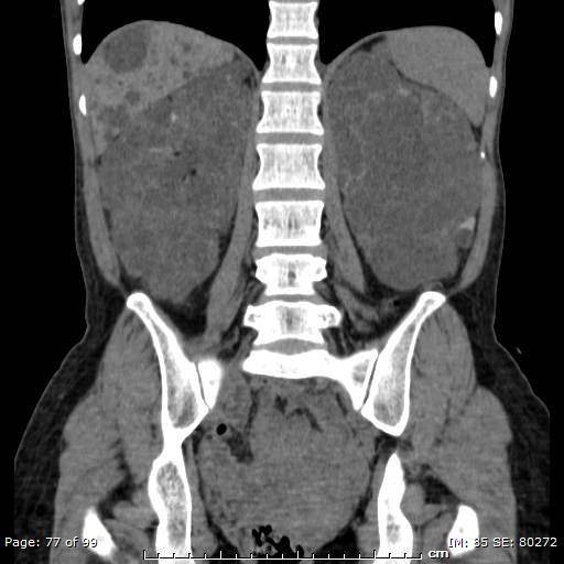 File:Autosomal dominant polycystic kidney disease (Radiopaedia 44122-47684 Coronal 18).jpg