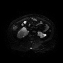 Autosomal dominant polycystic kidney disease (Radiopaedia 50259-55611 Axial DWI 32).jpg