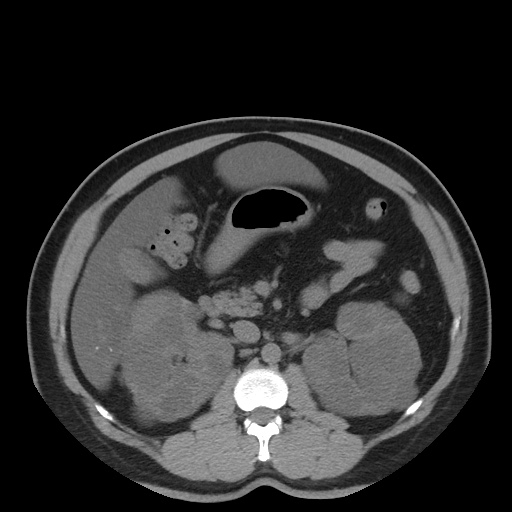 Autosomal dominant polycystic kidney disease (Radiopaedia 50259-55612 Axial non-contrast 35).jpg