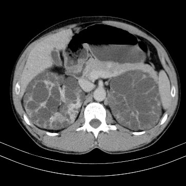 Autosomal dominant polycystic kidney disease (Radiopaedia 66349-75582 B 30).jpg