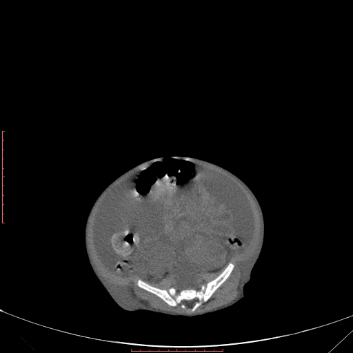 Autosomal recessive polycystic kidney disease associated with Caroli disease (Radiopaedia 61932-69984 Axial non-contrast 288).jpg