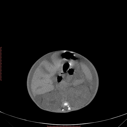 Autosomal recessive polycystic kidney disease associated with Caroli disease (Radiopaedia 61932-69984 B 188).jpg
