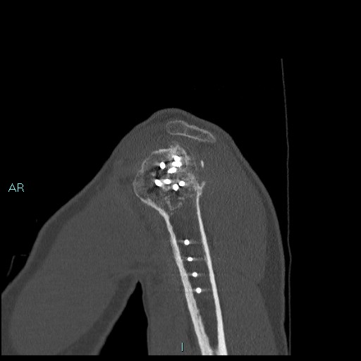 Avascular necrosis after fracture dislocations of the proximal humerus (Radiopaedia 88078-104655 Sagittal bone window 18).jpg