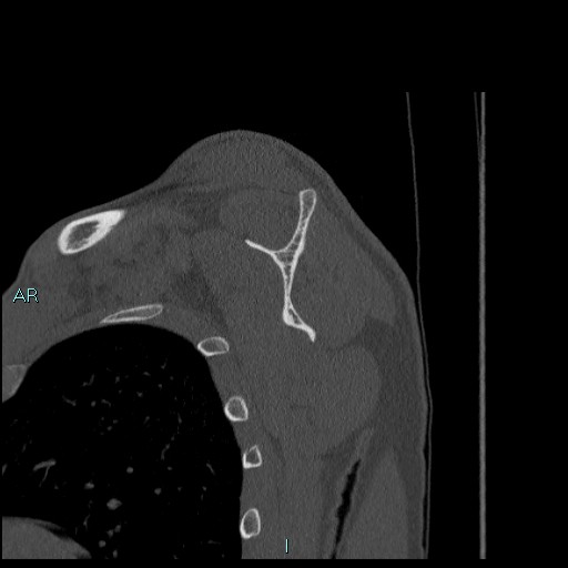 Avascular necrosis after fracture dislocations of the proximal humerus (Radiopaedia 88078-104655 Sagittal bone window 45).jpg