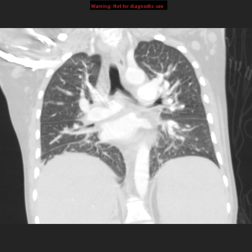 File:Avascular necrosis in sickle cell disease (Radiopaedia 17448-17152 B 72).jpg