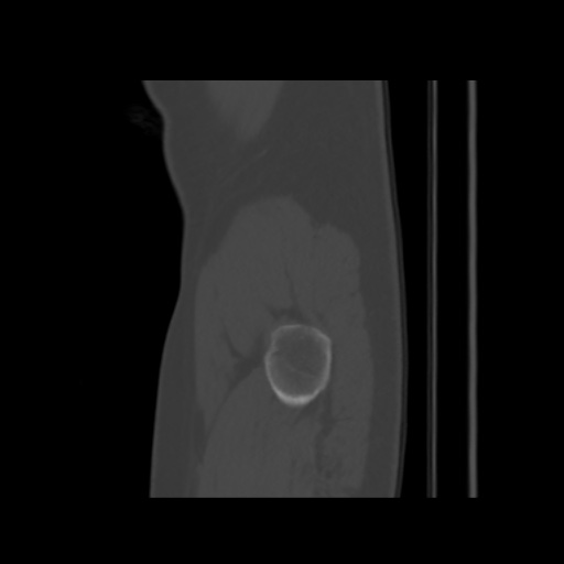 Avascular necrosis of the hip (Radiopaedia 61503-69467 B 59).jpg