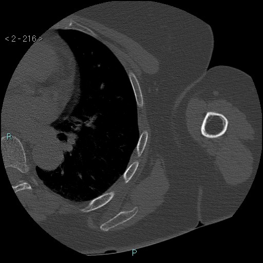 File:Avascular necrosis of the shoulder - Cruess stage I (Radiopaedia 77674-89887 Axial bone window 54).jpg