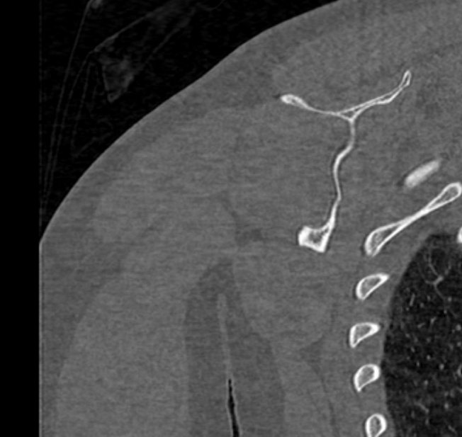 Avulsion fracture - greater tuberosity of humerus (Radiopaedia 71216-81514 Coronal bone window 65).jpg