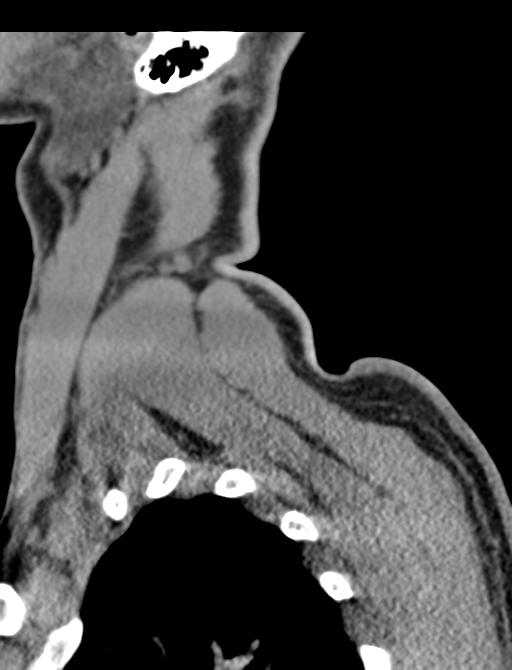 Axis peg fracture (type 3) and atlas lateral mass (type 4) fracture (Radiopaedia 37474-39324 D 75).png