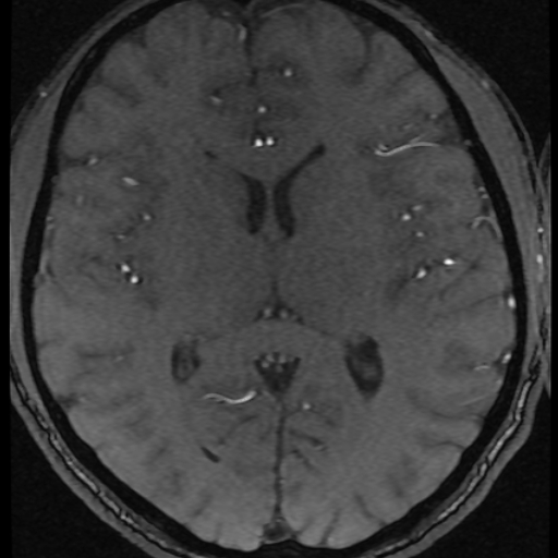 Azygos anterior cerebral artery (Radiopaedia 17059-16756 Axial MRA 6).jpg