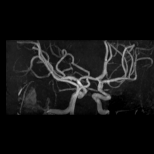 File:Azygos anterior cerebral artery (Radiopaedia 17059-16756 MRA 2).jpg
