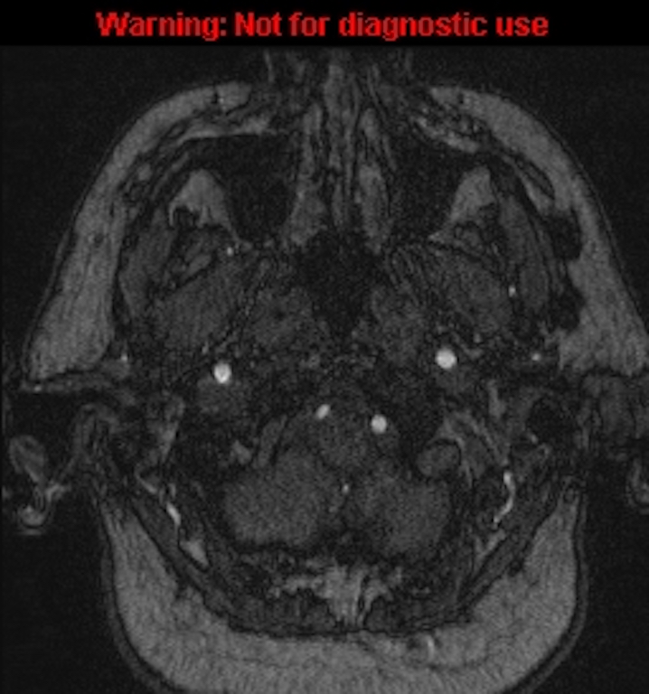 Azygos anterior cerebral artery (Radiopaedia 59325-66677 Axial MRA 4).jpg