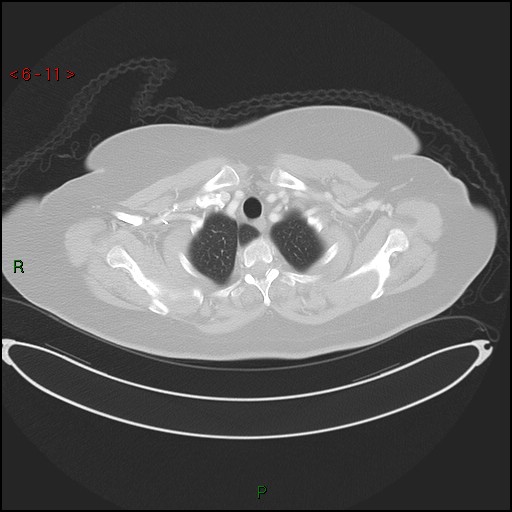 Azygos fissure and lobe (Radiopaedia 47620-52278 Axial lung window 11).jpg
