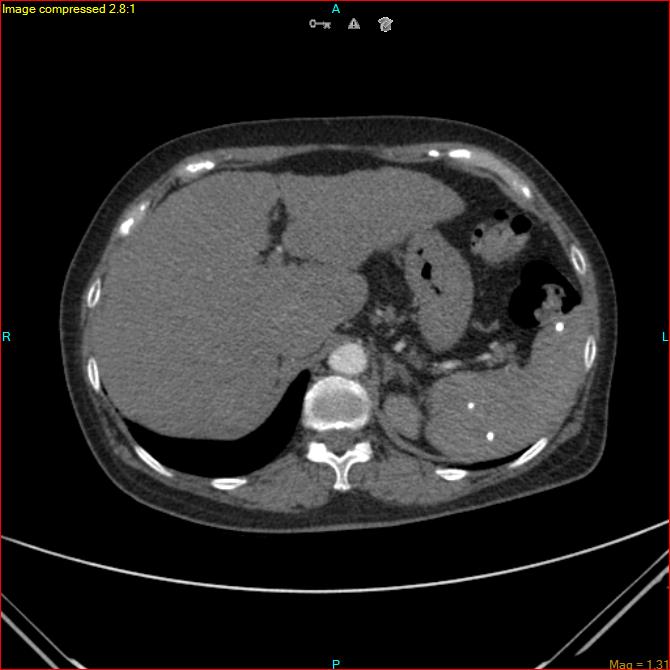 Azygos vein aneurysm (Radiopaedia 77824-90130 B 50).jpg