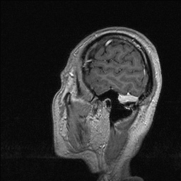 Balo concentric sclerosis (Radiopaedia 50458-55940 Sagittal T1 C+ 132).jpg