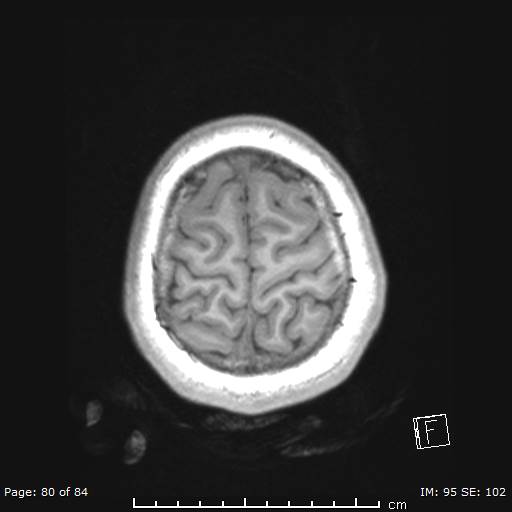 Balo concentric sclerosis (Radiopaedia 61637-69636 Axial T1 80).jpg