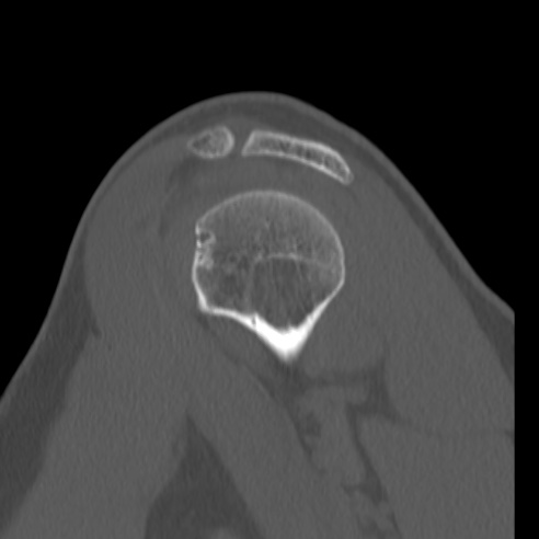 Bankart lesion (Radiopaedia 57256-64185 Sagittal bone window 21).jpg
