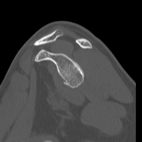 Bankart lesion (Radiopaedia 57256-64185 Sagittal bone window 30).jpg