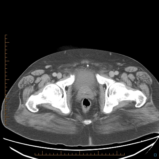 File:Bariatric balloon causing gastric outlet obstruction (Radiopaedia 54449-60672 A 42).jpg