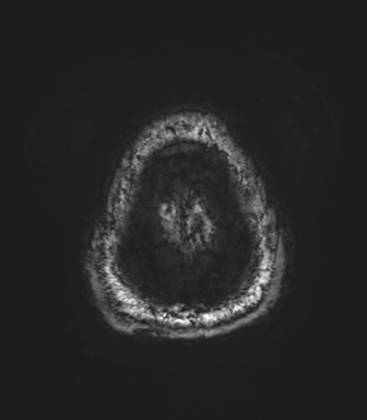 Basal ganglia hemorrhage - hypertensive (Radiopaedia 42227-45303 Axial SWI magnitude 86).png