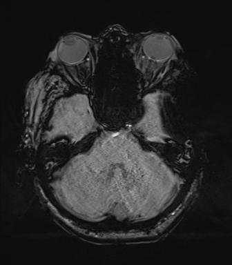 Basal ganglia metastasis (Radiopaedia 78928-91828 Axial SWI 21).png