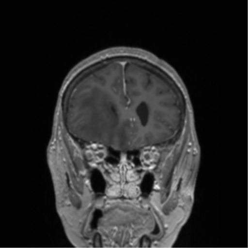 Basal ganglia metastasis (Radiopaedia 78928-91828 Coronal T1 C+ 64).png