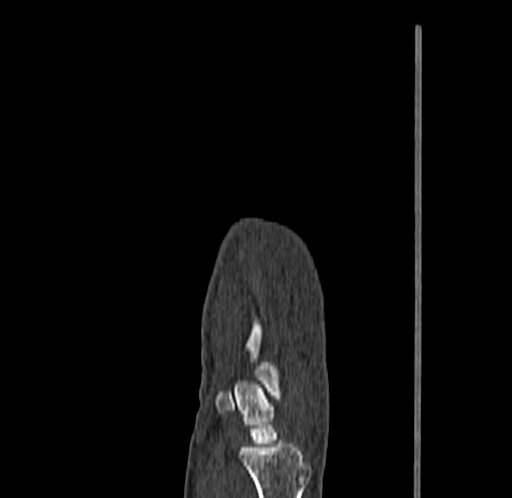 Base of 2nd metacarpal fracture (Radiopaedia 73741-84544 Sagittal bone window 30).jpg